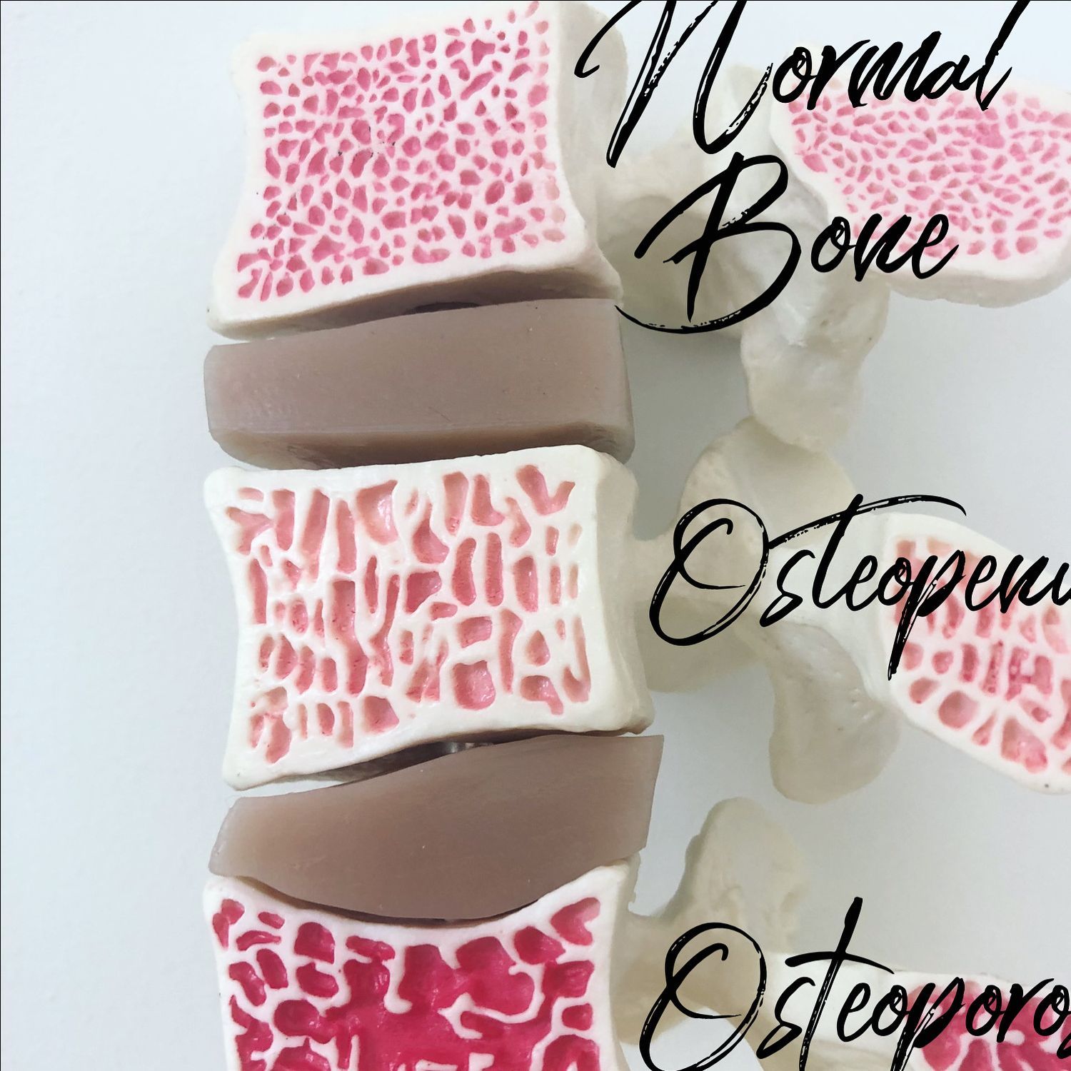 Osteoporosis What You Need To Know The Natural Practice